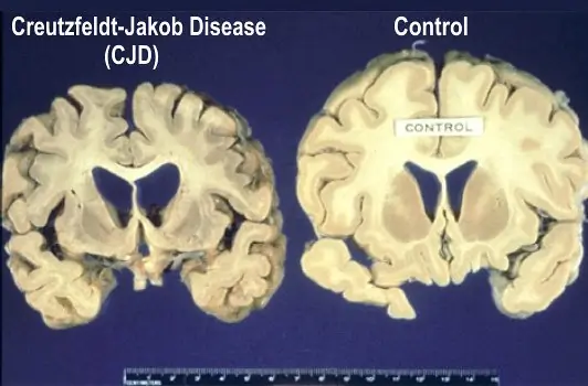 Microscopic slide showing protein misfolding associated with Creutzfeldt-Jakob disease.